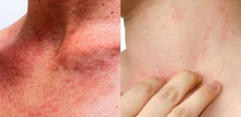 Kendisine karşı alerjisi var! Oto-alerji nedir?